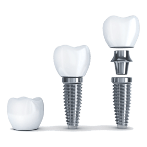 Dental Implants by Seattle dentist at Innovate Dentistry