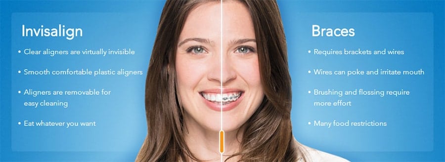 have Invisalign with our Seattle dentist at Innovate dentistry